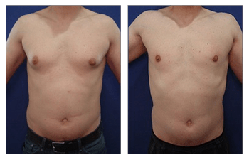 Why is it very much advisable for men to go for boob reduction surgery?
